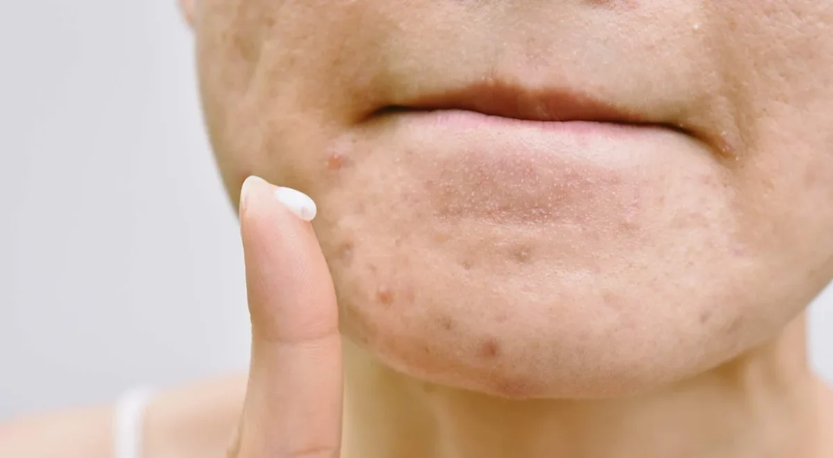 Cara Efektif Mengatasi Noda dan Bekas Jerawat dengan Acne Spot Treatment