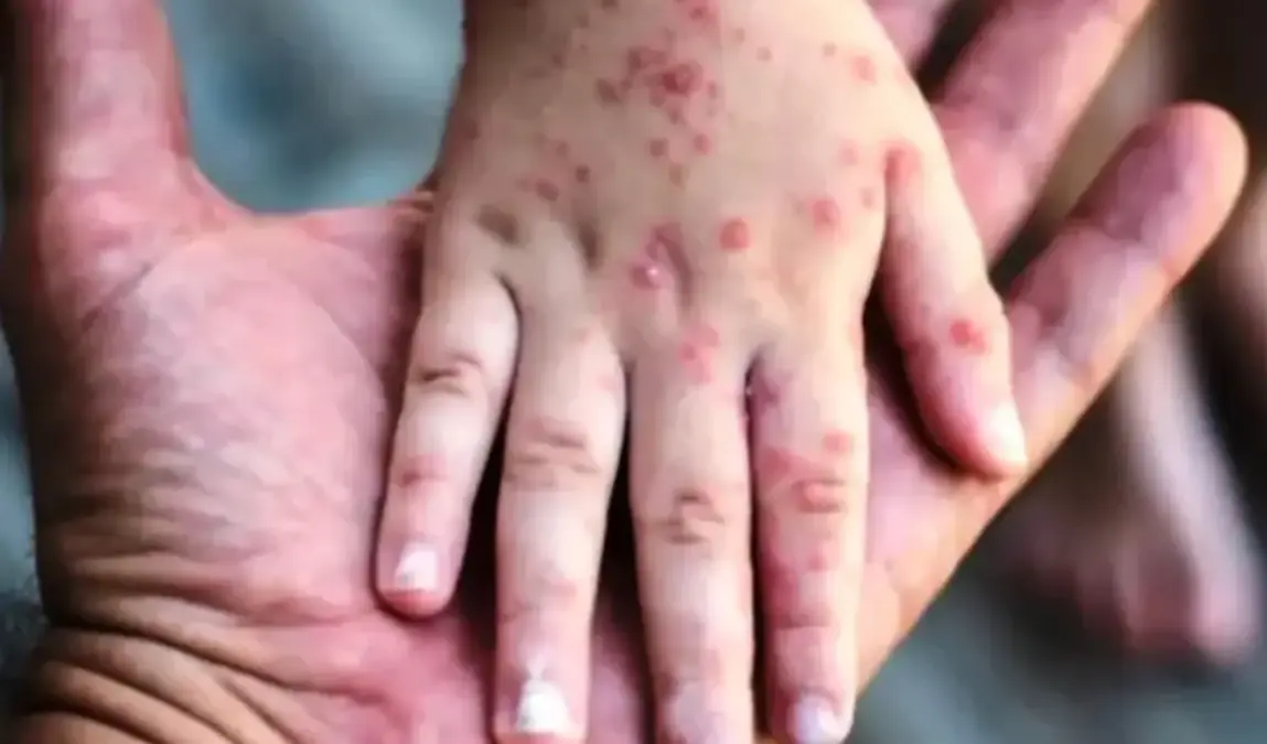 Dinas Kesehatan Bandung Barat Sebut Kasus Campak Bisa Menyerang Balita hingga Dewasa